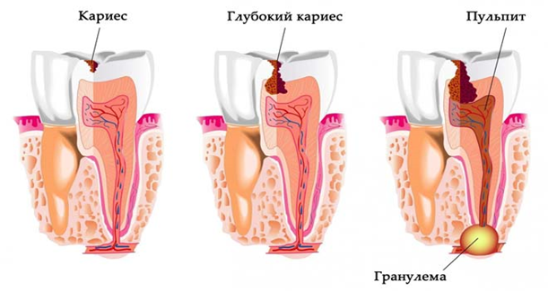 Гранулема на корне зуба: что это такое, симптомы, лечение в домашних условиях