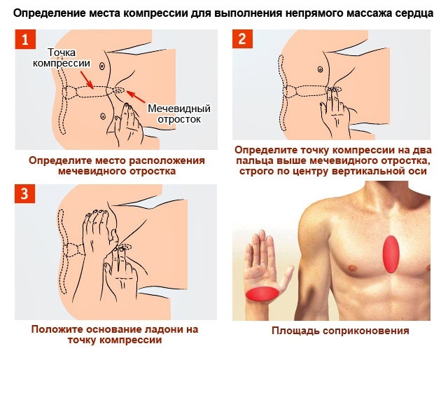 Восстановление сердечной деятельности. Способы восстановления сердечной деятельности. Непрямой массаж сердца. Механизм наружного массажа сердца. Как выполнять непрямой массаж сердца?