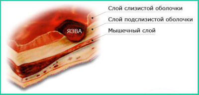 Язва двенадцатиперстной кишки лечение медикаментами - Всё о Здоровье