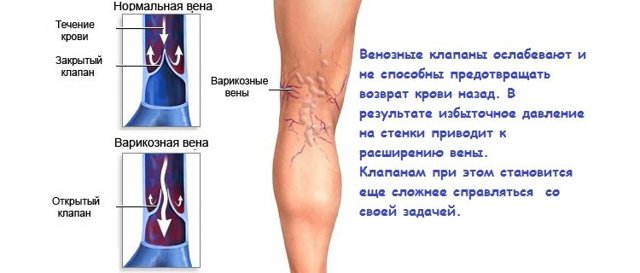 Вены на ногах вылезли что делать - Сайт о варикозе