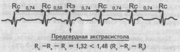 Монотопные экстрасистолы