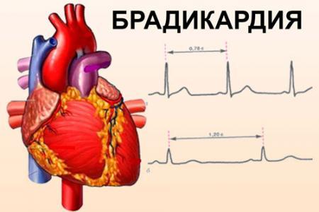 Лечится ли аритмия сердца