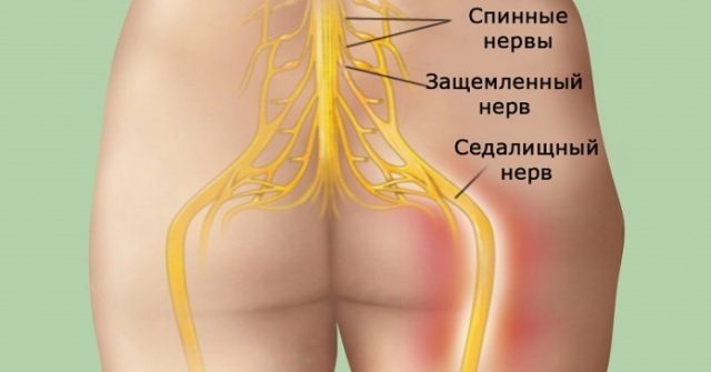 Воспаление и защемление седалищного нерва (ишиас) – Симптомы и лечение народными средствами