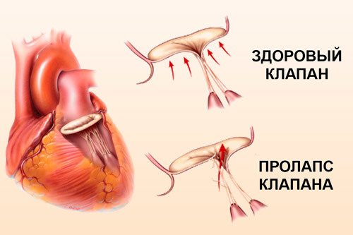 ПМК 1 степени - симптомы, лечение, диагностика