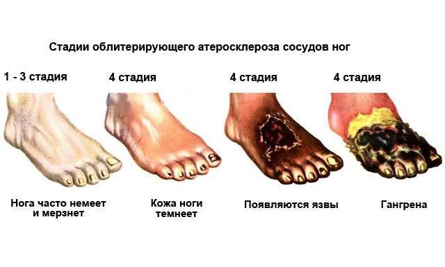 Нестенозирующий атеросклероз артерий