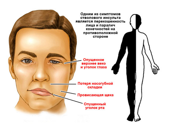 Инсульт левая или правая сторона, последствия, сколько живут