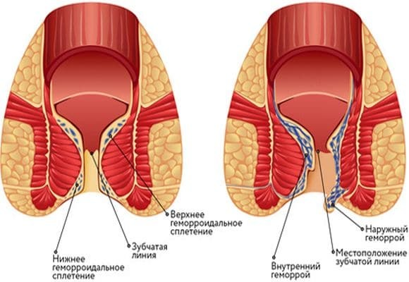 Геморроидальные узлы: как лечить геморройные шишки