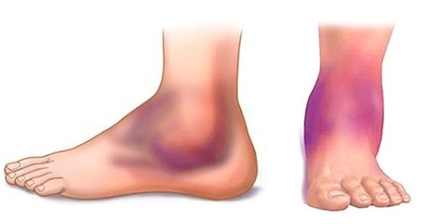 Заговор от тромбофлебита