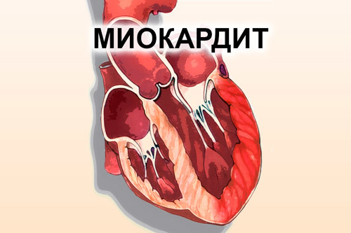 Картинки ЭКГ при нарушениях ритма