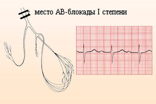 Тенденция к брадикардии у ребенка - Все про гипертонию