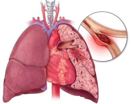 Пароксизмальная мерцательная аритмия: причины, лечение