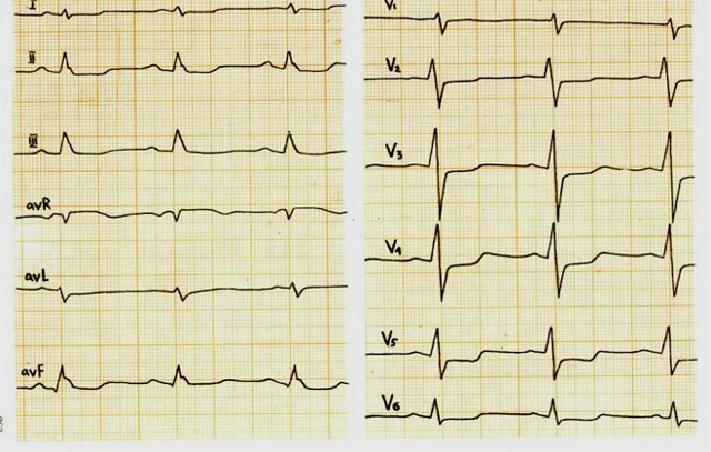 Признаки ишемии — E-Cardio