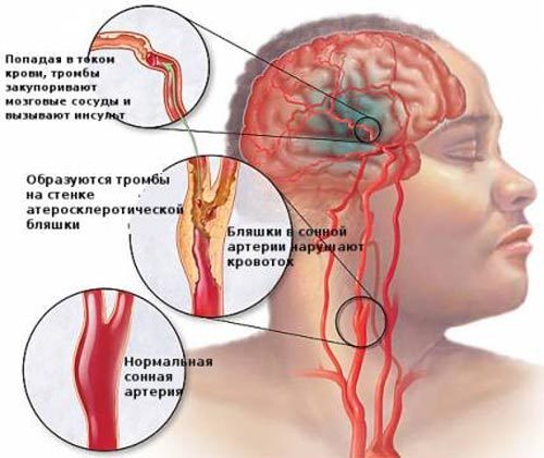 Что такое УЗДГ сосудов шеи и головы: как делают и что показывает УЗИ головного мозга, цена и расшифровка