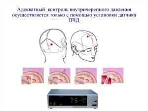 Неинвазивный мониторинг ВЧД у детей