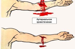 Последствия потери крови.