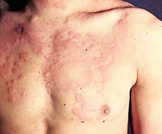 Крапивница у взрослых: симптомы и лечение, фото заболевания