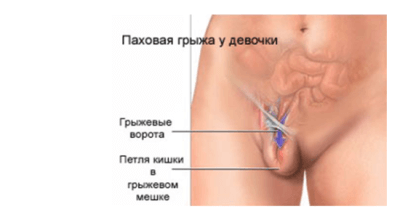 Паховая грыжа у детей (мальчиков и девочек): фото, лечение и операция по удалению