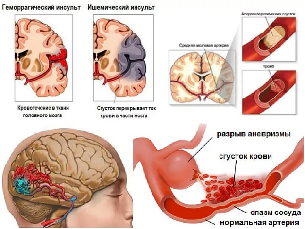 Питание при микроинсульте головного мозга – Популярные диеты