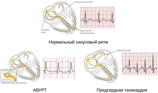 Тахикардия - причины, признаки, симптомы и лечение