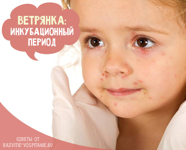 Ветрянка у детей симптомы и лечение в домашних условиях, инкубационный период, профилактика, начало, Комаровский