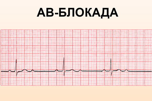 Картинки ЭКГ при нарушениях ритма