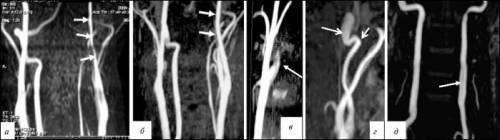 Внутренняя сонная артерия