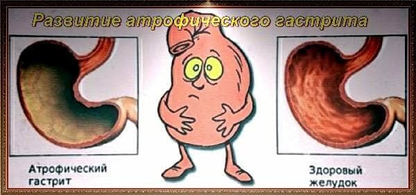 Хронический атрофический гастрит симптомы и лечение у взрослых
