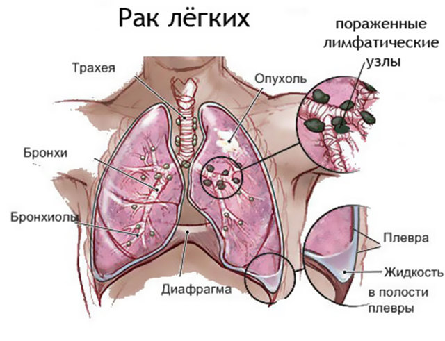 Рак легких – признаки, симптомы, стадии и лечение