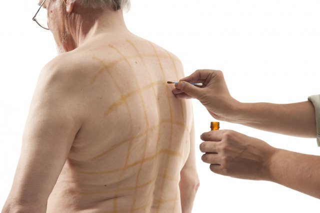 Лечение гипертонии йодом (по индийскому методу)