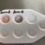 Определение группы крови по цоликлонам: как проводят, расшифровка результатов
