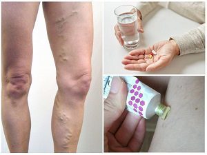 Почему вздуваются вены на руках и ногах: причины, лечение, профилактика