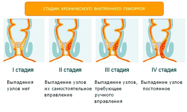 Лечение геморроя 1, 2, 3 и 4 стадии - современные операции