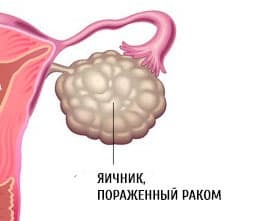 Причины боли в яичниках у женщин и как лечить