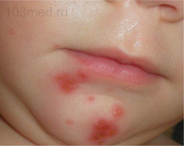 Стрептодермия у детей: фото, симптомы и лечение