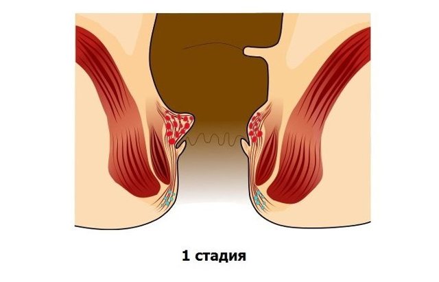 Первая стадия геморроя: лечение, причины, симптомы