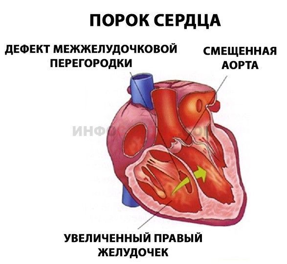 Сердце работает с перебоями замирает чем лечить — Сердце