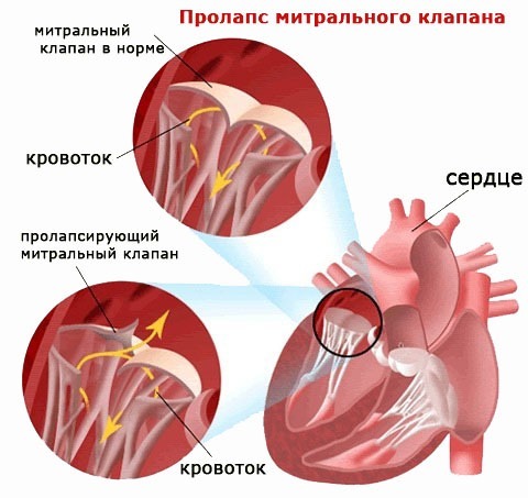 Порок митрального клапана сердца