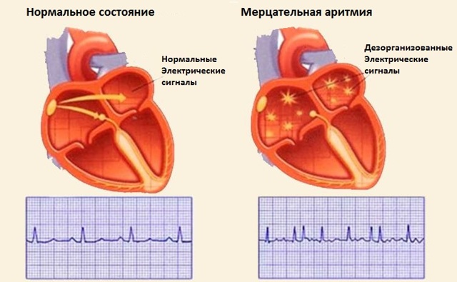 Прижигание при аритмии сердца — Сердце