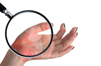 Рожа на ноге фото начальная стадия: Как начинается? - BadAcne