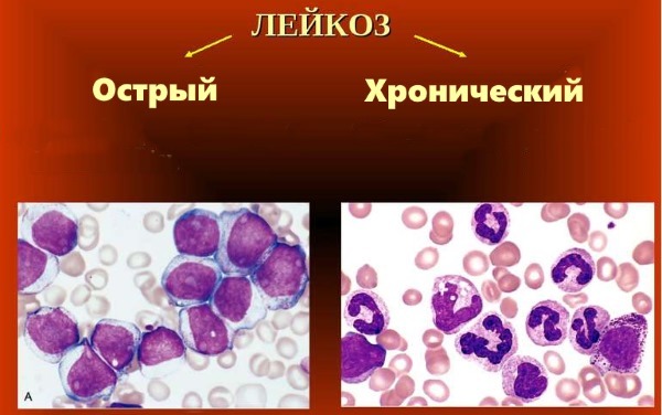 Сегментоядерные нейтрофилы повышен: у ребенка и взрослого, причины