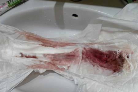 Если имплантация происходит за день до месячных