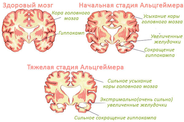 Единичные очаги в белом веществе головного мозга - результаты МРТ