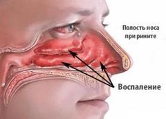 Постоянное отхаркивание слизи – причины и лечение