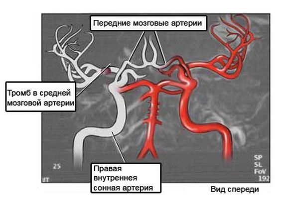 Тромб в сонной артерии: лечение, симптомы и удаление
