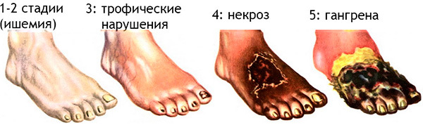 Артерии: роль и функция. Болезни артерий