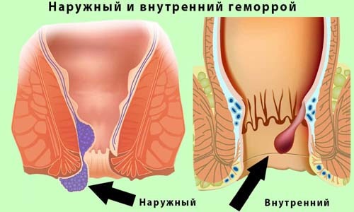 Народные средства и методы лечения болезней: рецепты от артрита и геморроя