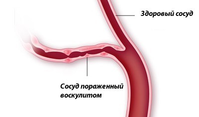 Воспаление сосудов: глаз, мозга и конечностей