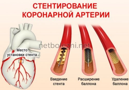 Стентирование коронарных артерий: операция, послеоперационный период, реабилитация