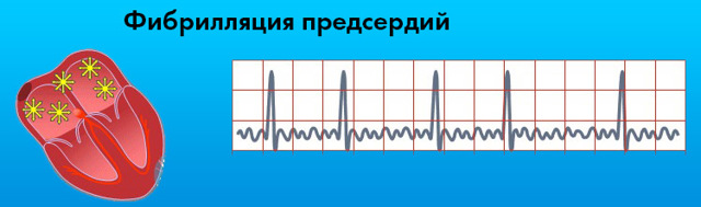 Картинки ЭКГ при нарушениях ритма