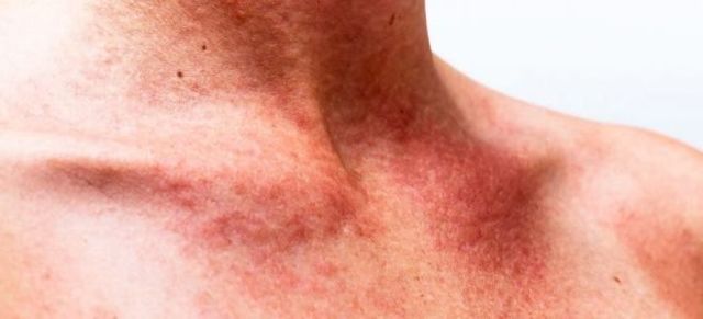 Васкулит мозга